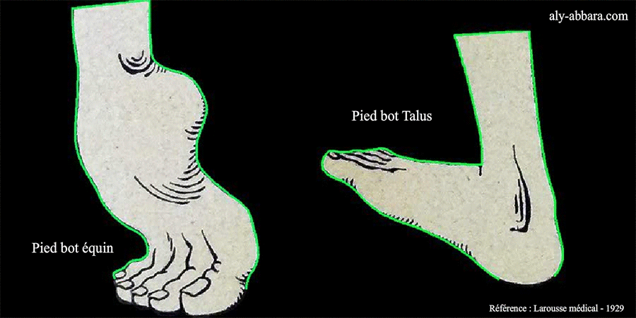 Pieds bot : talus et équin - Illustration