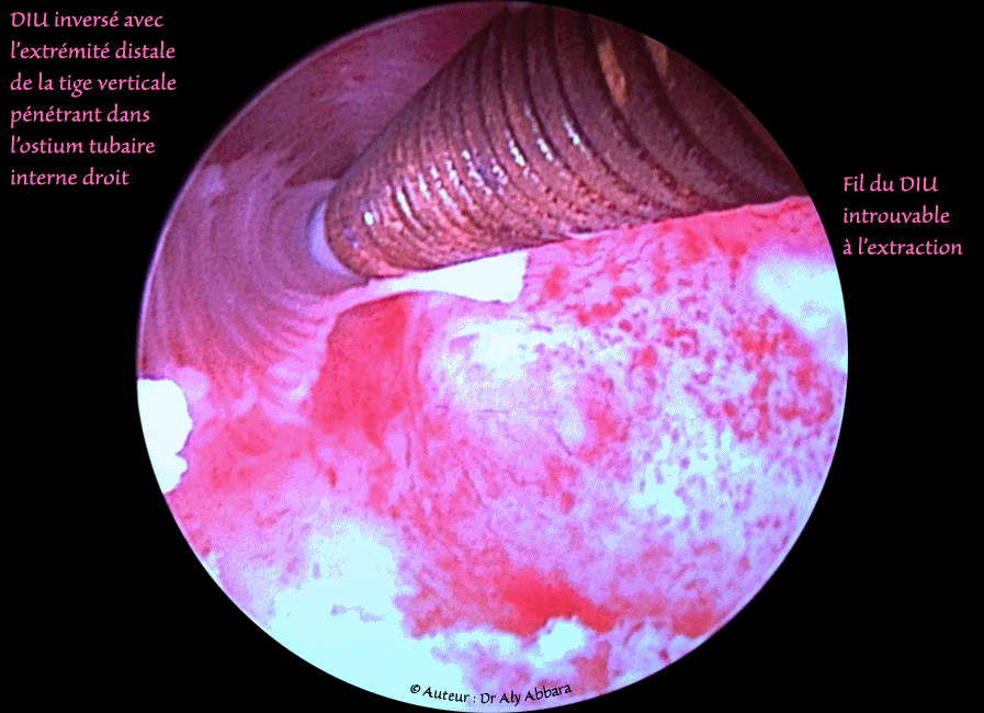 DIU inversé et pénétrant par l'extrémité distale de sa tige verticale, dans l'ostium tubaire interne droit