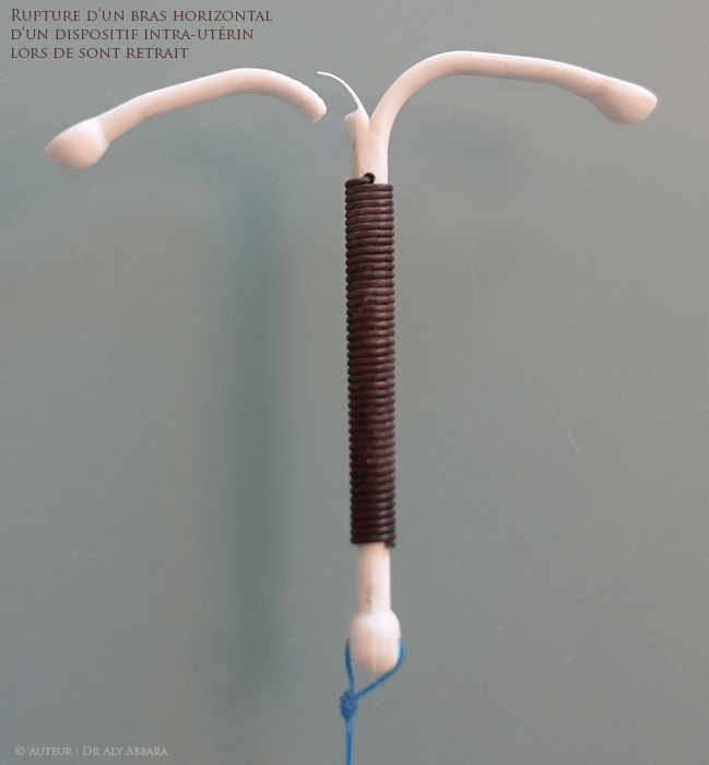 DIU inversé et pénétrant par l'extrémité distale de sa tige verticale, dans l'ostium tubaire interne droit