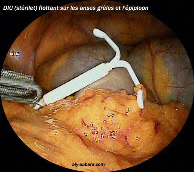 DIU flottant dans la cavité utérine suite à une perforation de l'utérus lors de la pose de ce ce DIU
