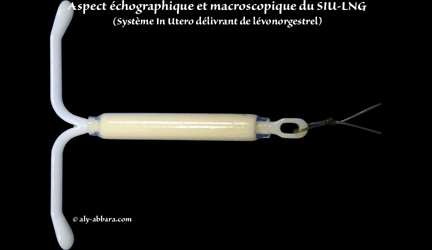 Image échographique montrant l'aspect l'apparition d'un kyste fonctionnel à l'ovaire gauche, deux mois après la pose de dispositif intra-utérin hormonal