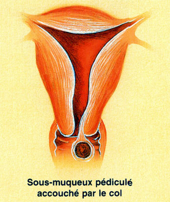 Fibrome cervical pédiculé et accouché par le col utérin