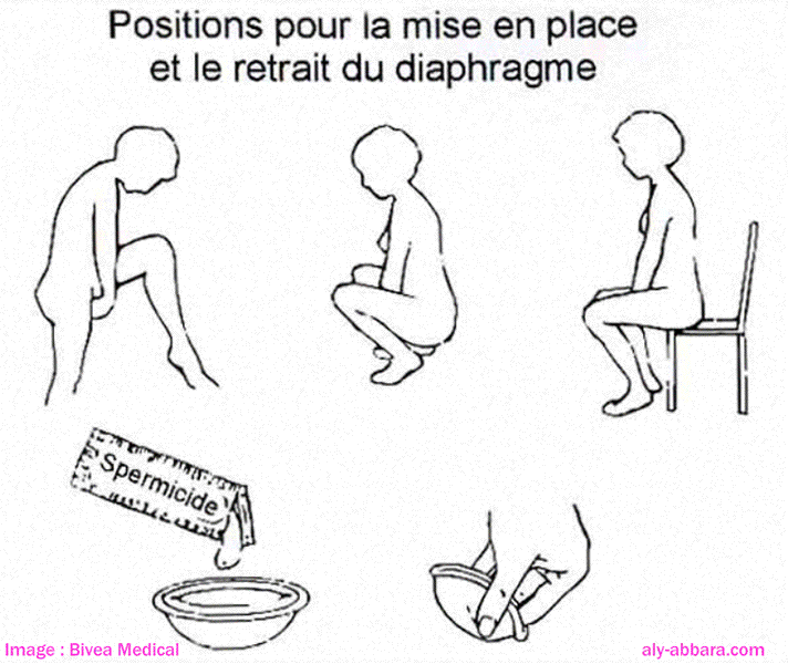 Diaphragme vaginal - Technique de pose