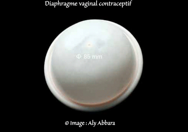Diaphragme vaginal - Un des moyens contraceptifs mécaniques (barrières)