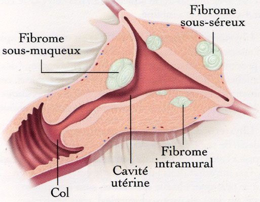 Fibrome cervical pédiculé et accouché par le col utérin