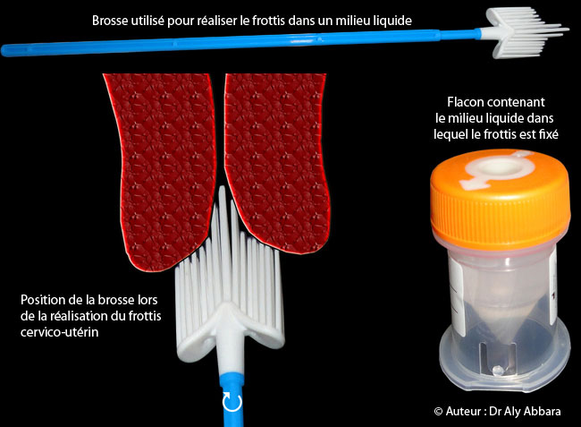 Materiel utilisé pour la réalisation du frottis cervico-utérin dans un milieu liquide