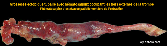 Grossesse ectopique tubaire à l'origine de la constitution d'un hématosalpinx étendu sur la portion moynene et distale de la trompe