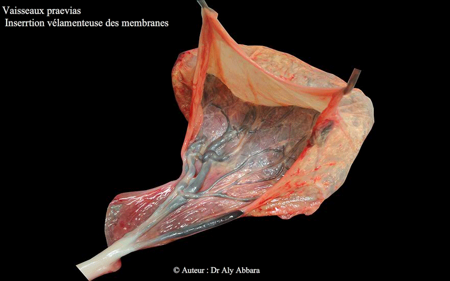 Insertion vélamenteuse du cordon ombilical -Grossesse de 39,5 SA