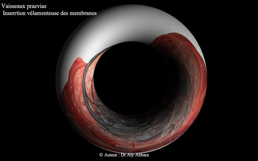 Insertion vélamenteuse du cordon ombilical -Grossesse de 39,5 SA -Images en 3D