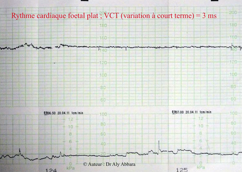 Rythme cardiaque foetal (RCF) plat