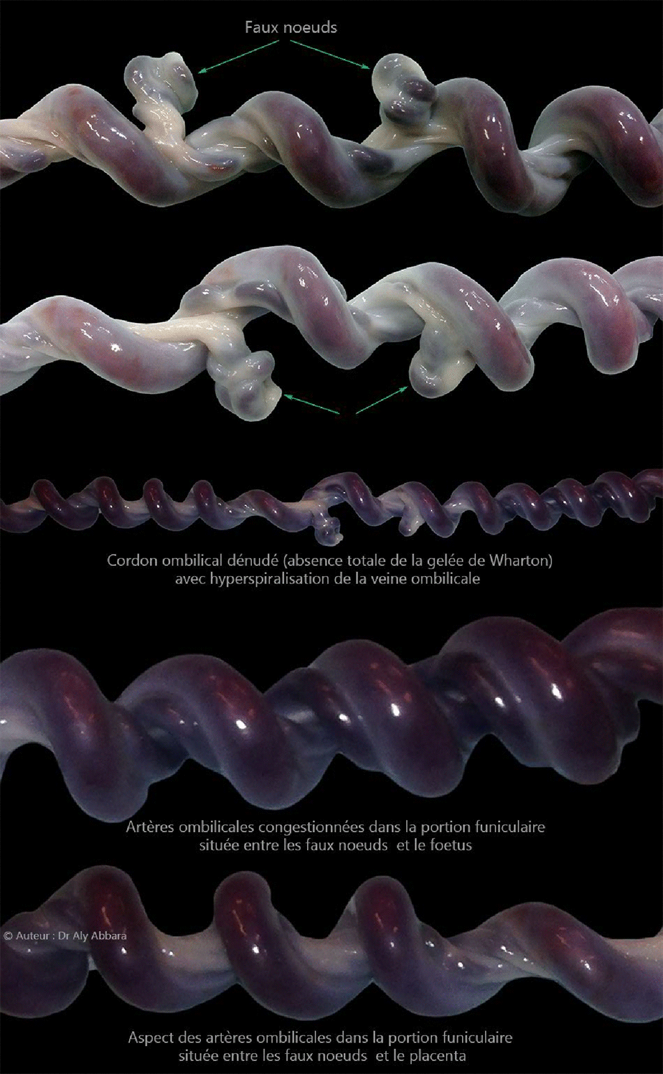 Cordons ombilicaux - Faux noeuds du cordon