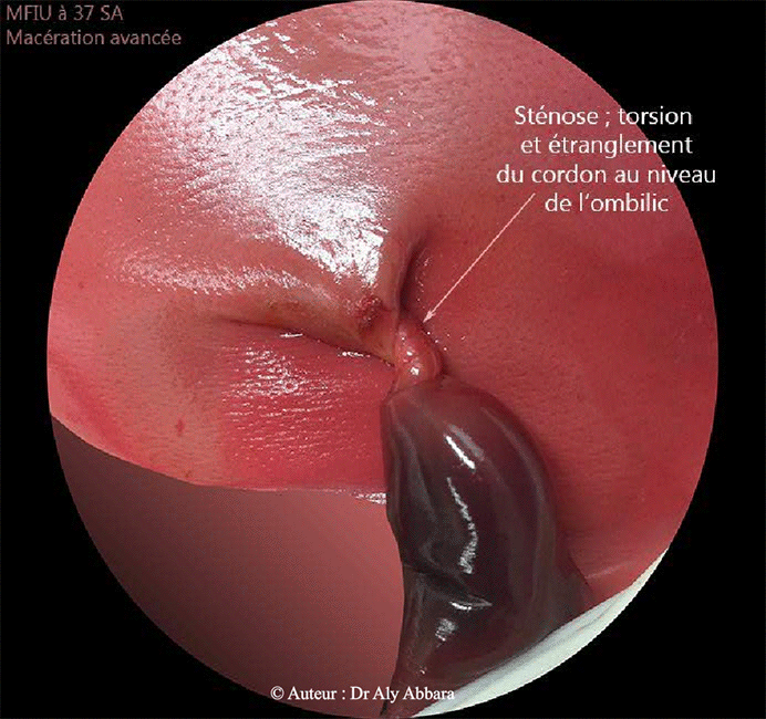 Image clinique - Torsion et étranglement du cordon au niveau de son insertion à la paroi abdominale - MFIU à 37 SA