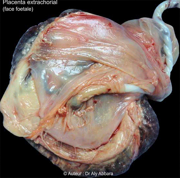 Placenta extrachorial - Image clinique commentée