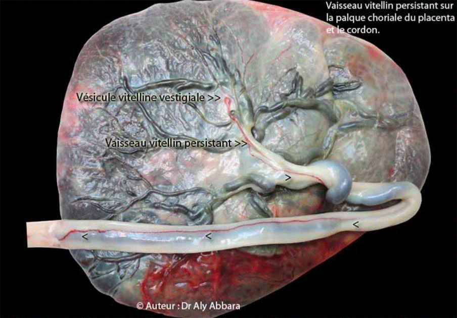 Placenta et cordon ombilical - Persistance d'un vaisseau vitellin