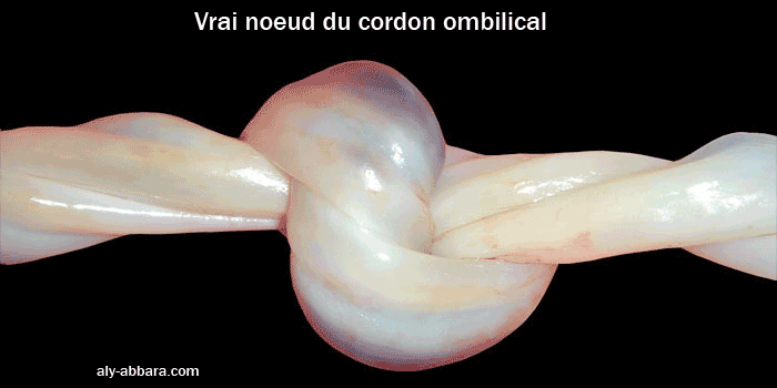 Vrai noeud du cordon