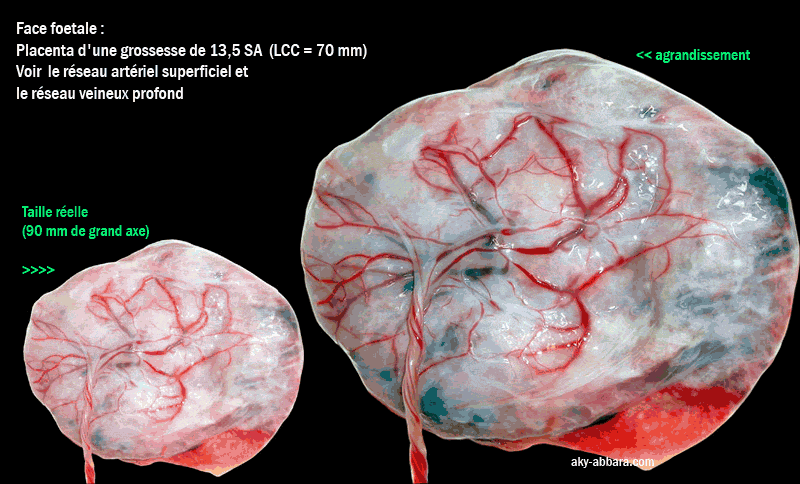 La face foetale du placenta d'une grossesse âgée de 13,5 semaines d'aménorrhée