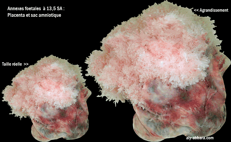 La face maternelle du placenta et des membranes amniotiques d'une grossesse âgée de 13,5 semaines d'aménorrhée