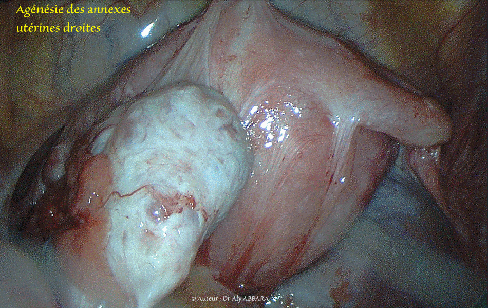 Agénésie des annexes utérines droites (trompe et ovaire), غياب خلقي للبوق والمبيض الأيمنين