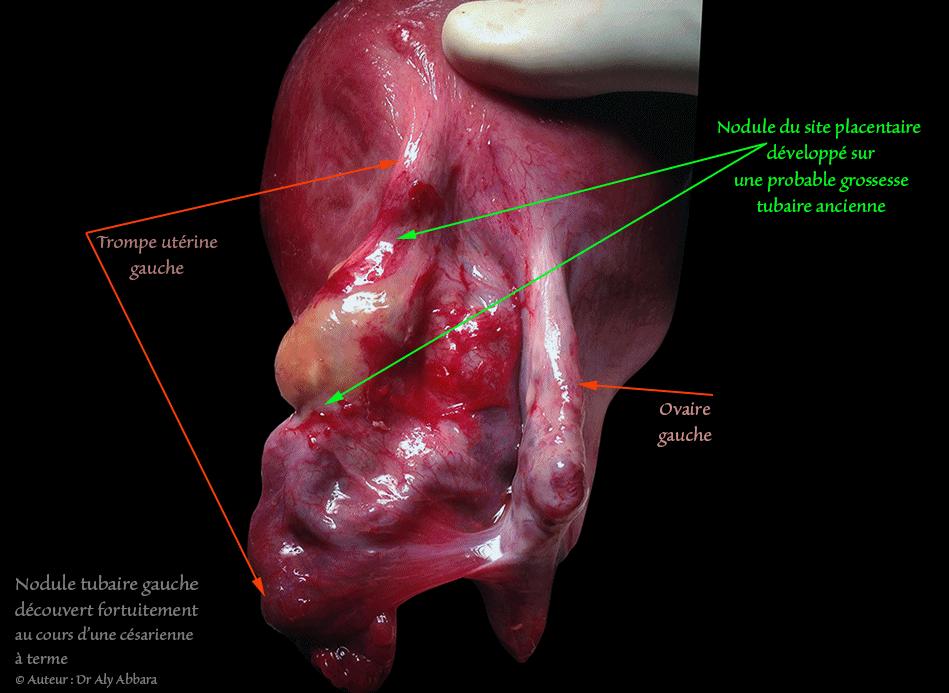 Nodule du site placentaire évoluant au sein d'une ancienne grossesse extra-utérine tubaire gauche - découvente fortuite au cours d'une césarienne à terme