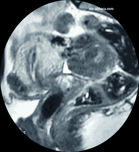 Utérus myomateux porteur de deux myomes sous-séreux, le premier est postérieur, volumnineux et pédiculé, le deuxième est oblong, sou-séreux sessile, situé sur la face intérieur de l'utérus, près de son isthme
