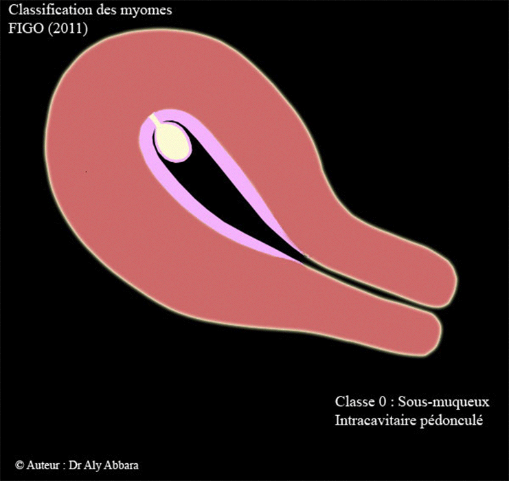 Myomes-utérins - Classification de FIGO en 8 classes
