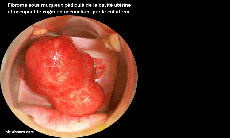 Fibrome utérin accouché par le col