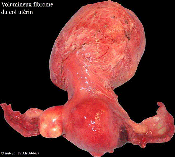 Utérus polymyomateux avec un volumineux myome cervical - Image clinique de la face postérieur de l'utérus