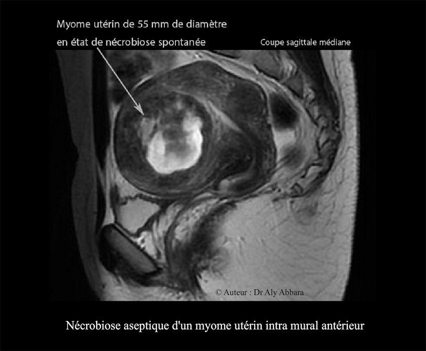 Myome utérin en état de nécrobiose aseptique - 55 mm de grand axe - Images IRM