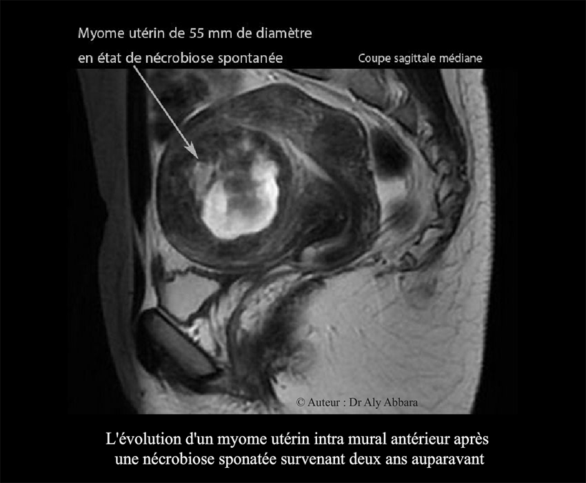 Myome utérin de 55 mm de diamètre en état de nécrobiose aseptique - Images IRM