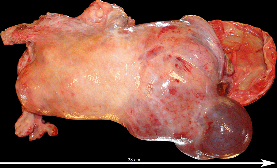 Utérus polymyomateux de 3800 g comportant deux volumineux myomes enkystés - Images cliniques