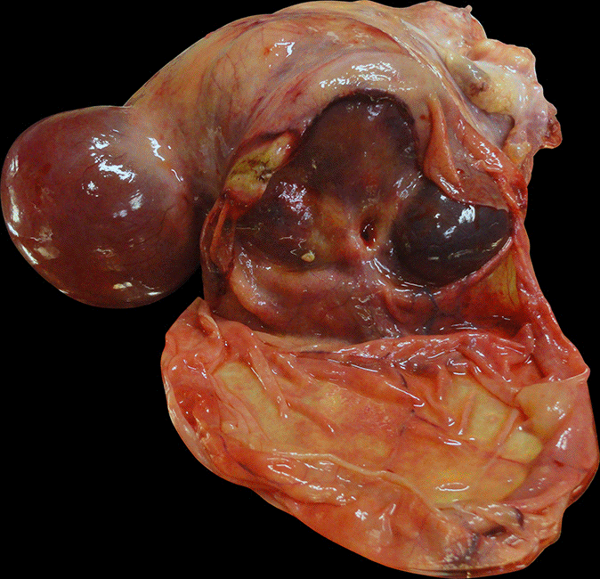 Utérus polymyomateux de 3800 g comportant deux volumineux myomes enkystés - Images cliniques