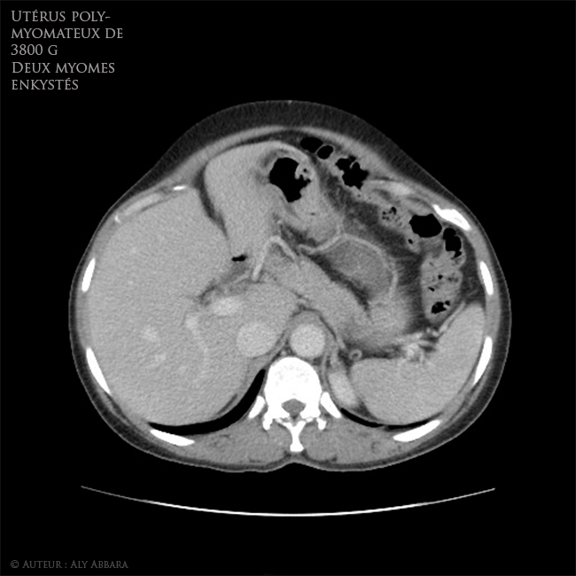 Utérus polymyomateux de 3800 g comportant deux volumineux myomes enkystés - Imagerie par scanner - coupes axiales