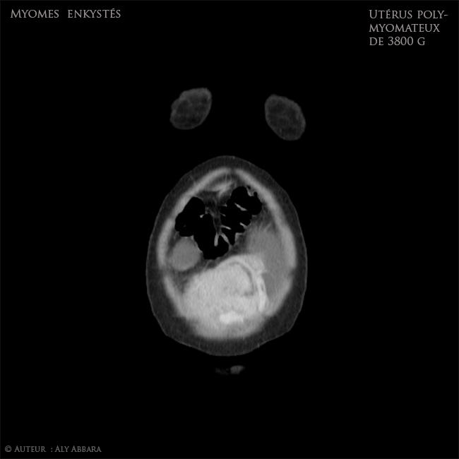 Utérus polymyomateux de 3800 g comportant deux volumineux myomes enkystés - Imagerie par scanner - coupes frontales