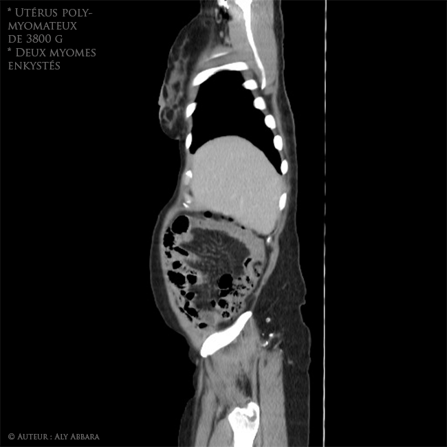 Utérus polymyomateux de 3800 g comportant deux volumineux myomes enkystés - Imagerie par scanner - coupes sagittales