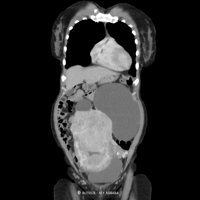 Utérus polymyomateux de 3800 g comportant deux volumineux myomes enkystés - Imagerie par scanner - coupes multiplans