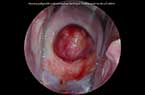 Myome utérin polypoïde endocervical et accouché par l'orifice externe du col utérin