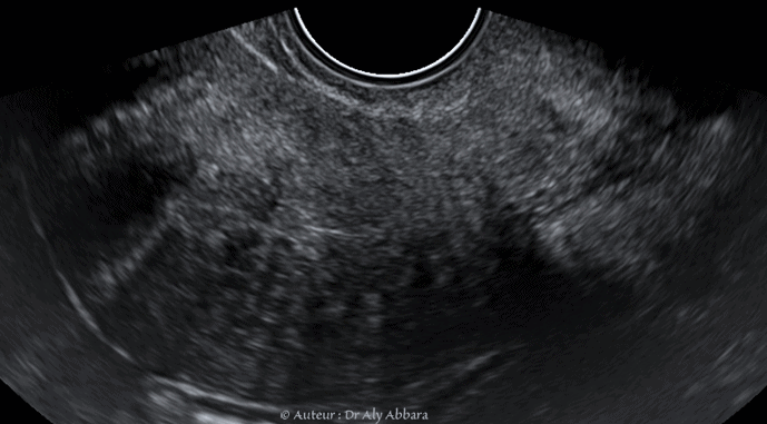 Fibrome polypoïde endocervical accouché par l'orifice externe du col utérin - ورم ليفي عنفي رحمي
