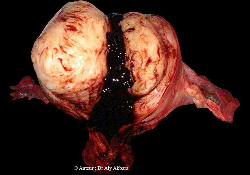 Utérus polymyomateux avec hématométrie due à une sténose de l'orifice externe du col utérin