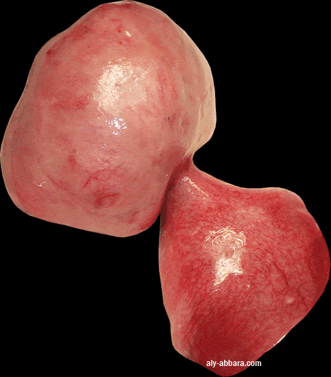 Myome sous séreux pédiculé de 80 x 55 mm, inséré sur la paroi postérieure du corps utérin, à 3 cm de la corne utérin