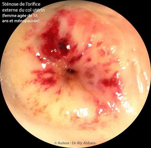 Sténose de l'orifice externe du col utérin à l'origine d'une hématométrie