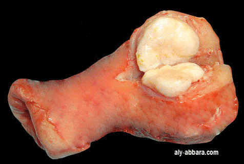 Utérus porteur d'un petit myome interstitiel au niveau du corps utérin (corne utérine)