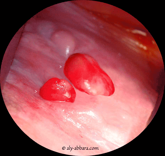 Deux granulomes  à corps étranger du vagin