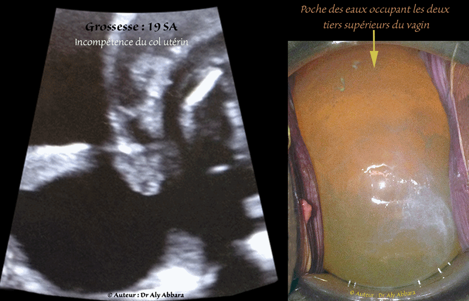 Grossesse de 18 SA - béance du col utérin ; poche des eaux atteignant l'orifice externe du col utérin