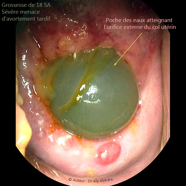 Grossesse de 18 SA - béance du col utérin ; poche des eaux atteignant l'orifice externe du col utérin