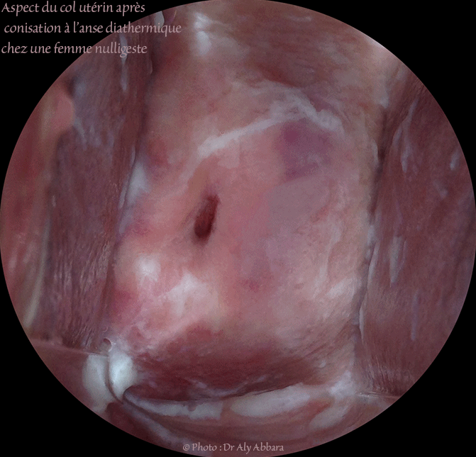 Aspect du col utérin subissant une conisation à l'aide de l'anse diathermique ; il s'agit d'une femme nulligeste