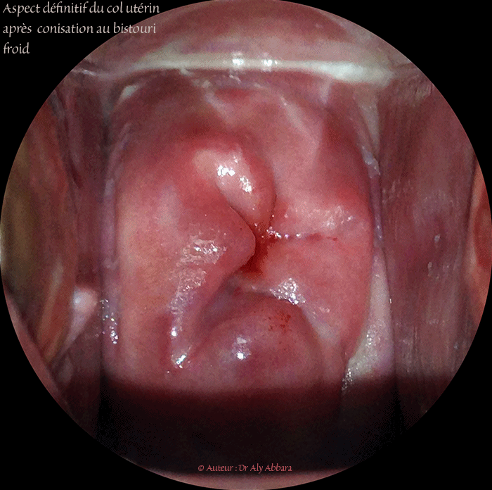 Aspect du col utérin après conisation au bistouri froid - مظهر عنق الرحم بعد الخزعة المخروطية بالمشرط البارد