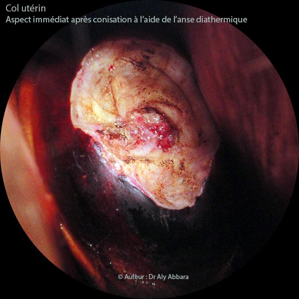 Conisation du col utérin à l'aide de l'anse diathermique