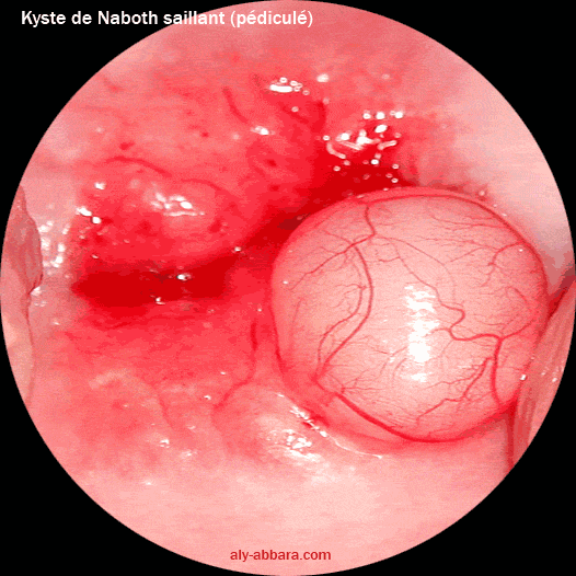 Kyste de Naboth saillant, pédiculé et évoluant sur la lèvre postérieure du col utérin