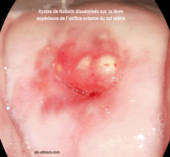 Kystes de Naboth disséminés sur la lèvre supérieure du col utérin