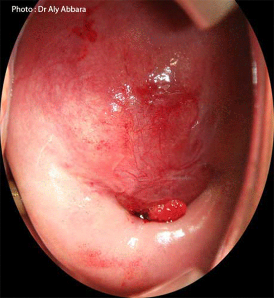 Myome intra-cervical utérin évoluant dans sa lèvre antérieure